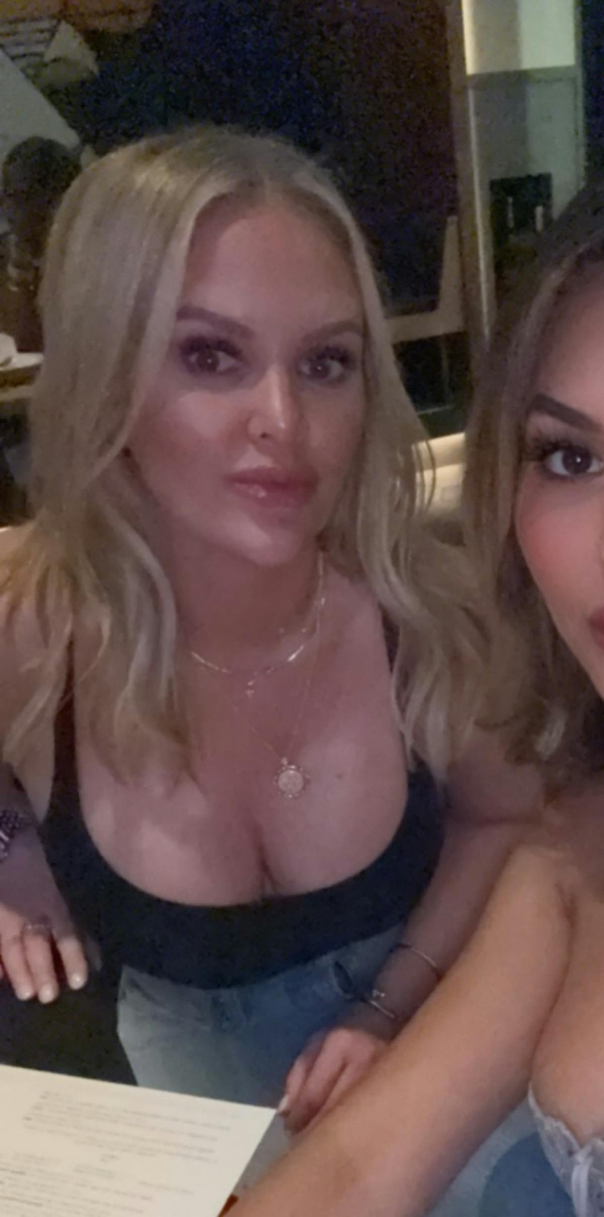 Patient Selfies Before & After Gallery - Patient 129014 - Image 1