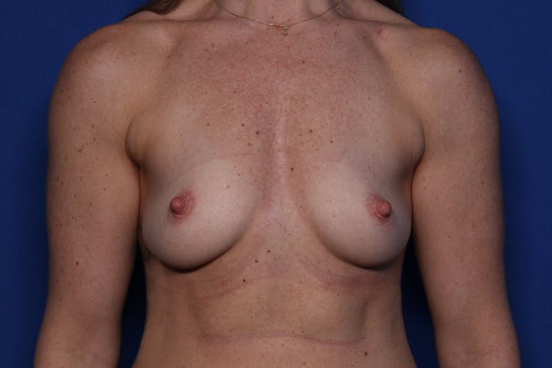 Breast Augmentation Before & After Gallery - Patient 935454 - Image 1