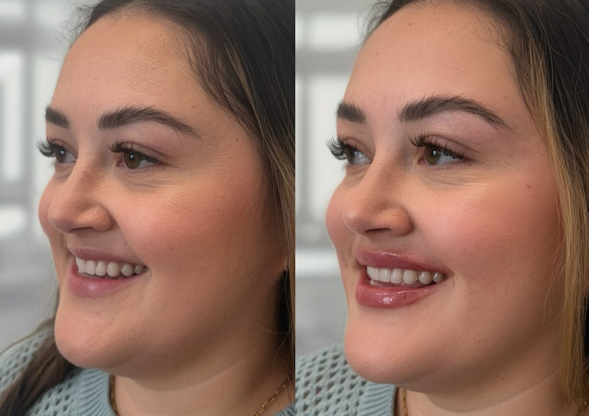 Lip Filler Before & After Gallery - Patient 123781 - Image 2