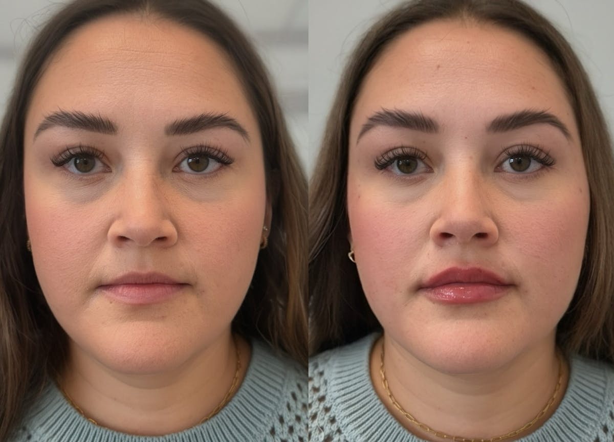 Lip Filler Before & After Gallery - Patient 123781 - Image 1