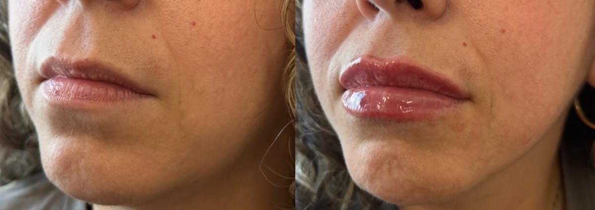 Lip Filler Before & After Gallery - Patient 154515 - Image 2