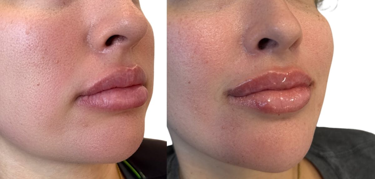 Lip Filler Before & After Gallery - Patient 408834 - Image 2
