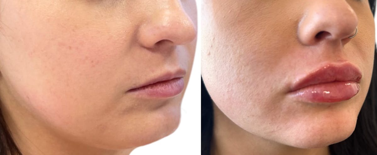 Juvéderm® Before & After Gallery - Patient 348169 - Image 2