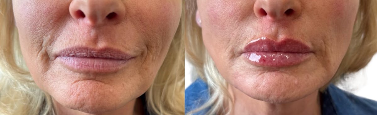 Lip Filler Before & After Gallery - Patient 184896 - Image 1