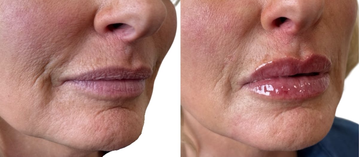Lip Filler Before & After Gallery - Patient 184896 - Image 2