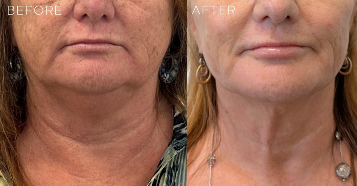 Morpheus8® Before & After Gallery - Patient 223375 - Image 2