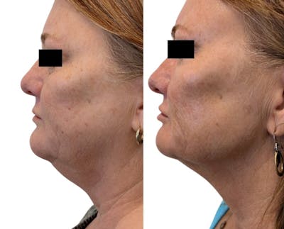 Morpheus8® Before & After Gallery - Patient 223375 - Image 1