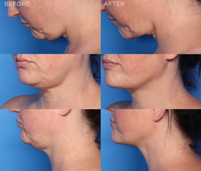 FaceTite Before and After Before & After Gallery - Patient 428886 - Image 1