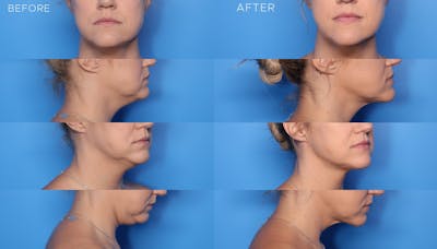 FaceTite Before and After Before & After Gallery - Patient 384330 - Image 1