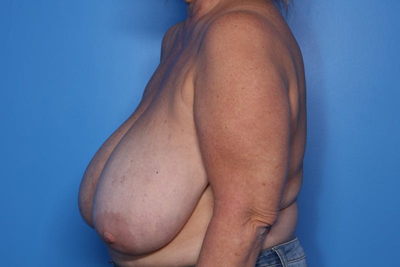 Breast Reduction Before & After Gallery - Patient 311598 - Image 5