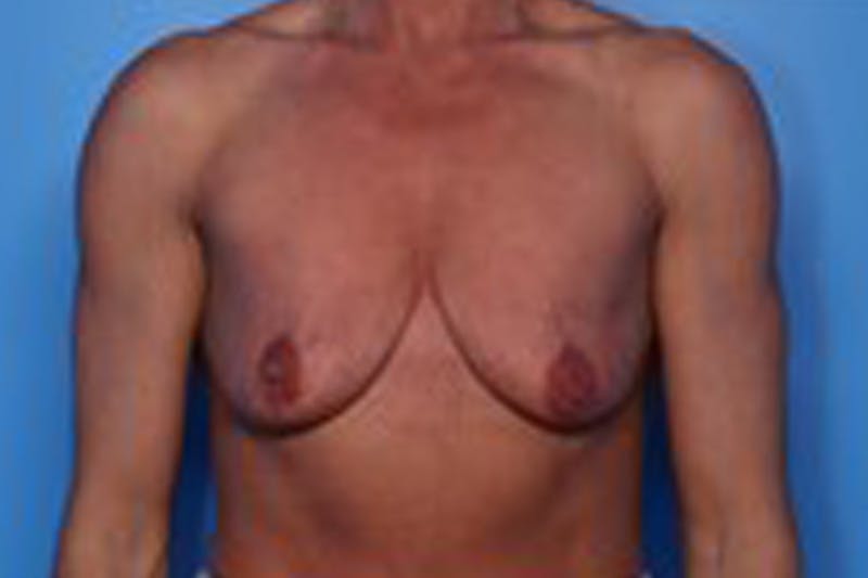 Breast Augmentation Before & After Gallery - Patient 226281 - Image 1