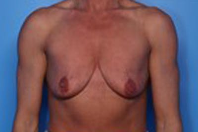 Breast Augmentation Before & After Gallery - Patient 226281 - Image 1