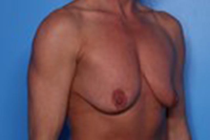 Breast Augmentation Before & After Gallery - Patient 226281 - Image 3