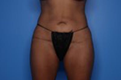 Body Lift Before & After Gallery - Patient 218647 - Image 1
