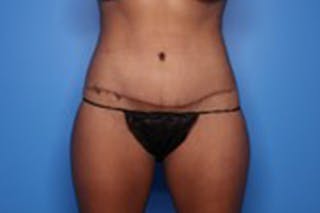 Body Lift Before & After Gallery - Patient 218647 - Image 2