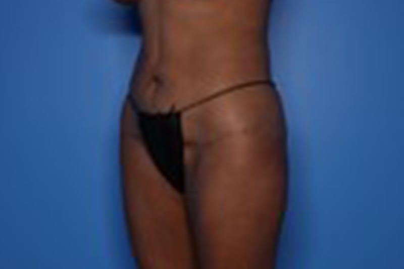 Body Lift Before & After Gallery - Patient 218647 - Image 3