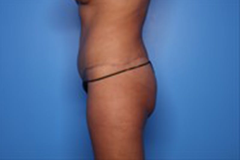 Body Lift Before & After Gallery - Patient 218647 - Image 6