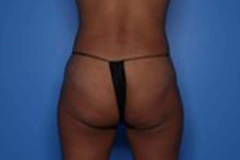 Body Lift Before & After Gallery - Patient 218647 - Image 11