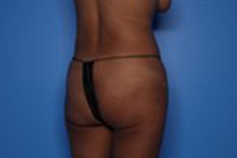 Body Lift Before & After Gallery - Patient 218647 - Image 9