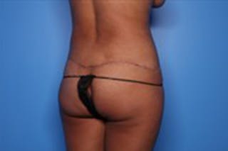 Body Lift Before & After Gallery - Patient 218647 - Image 10