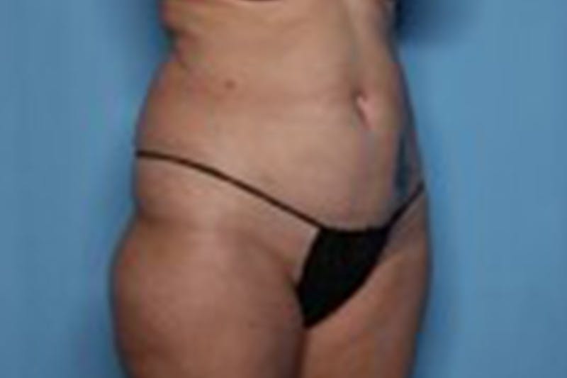 Liposuction Before & After Gallery - Patient 211307 - Image 3