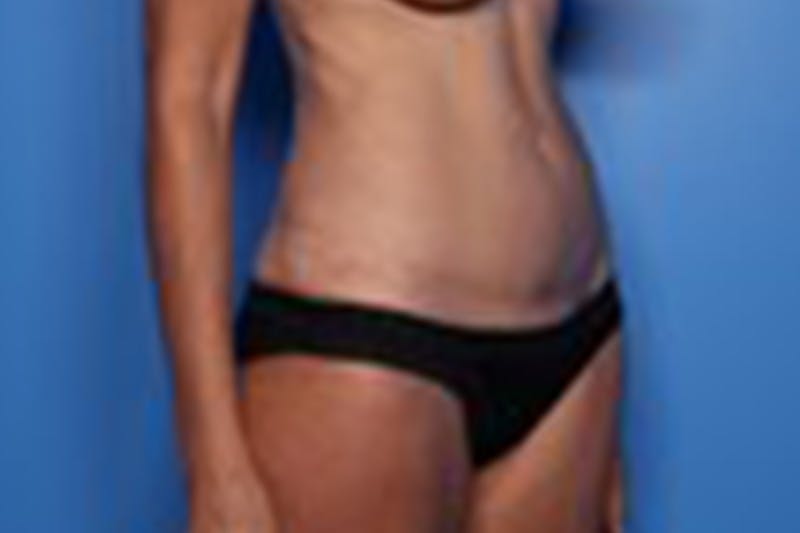Liposuction Before & After Gallery - Patient 211307 - Image 4