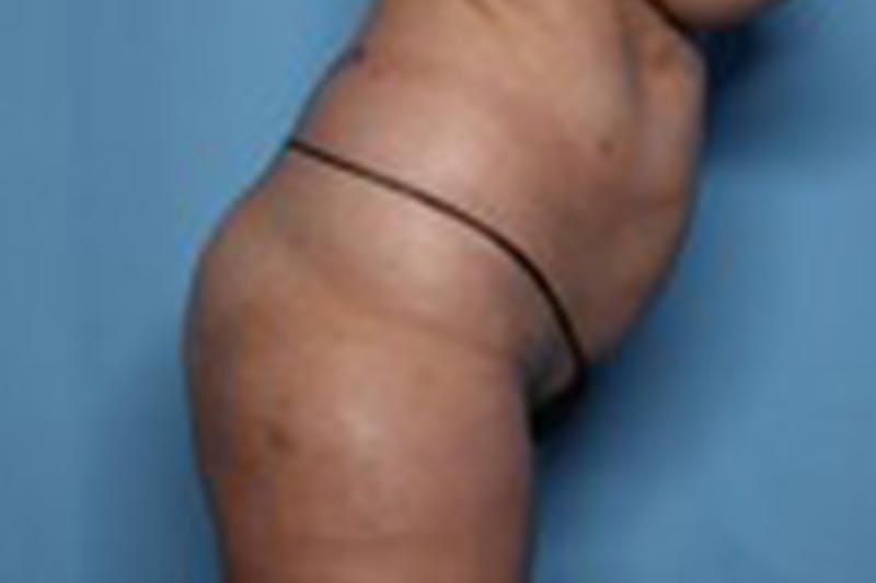 Liposuction Before & After Gallery - Patient 211307 - Image 7