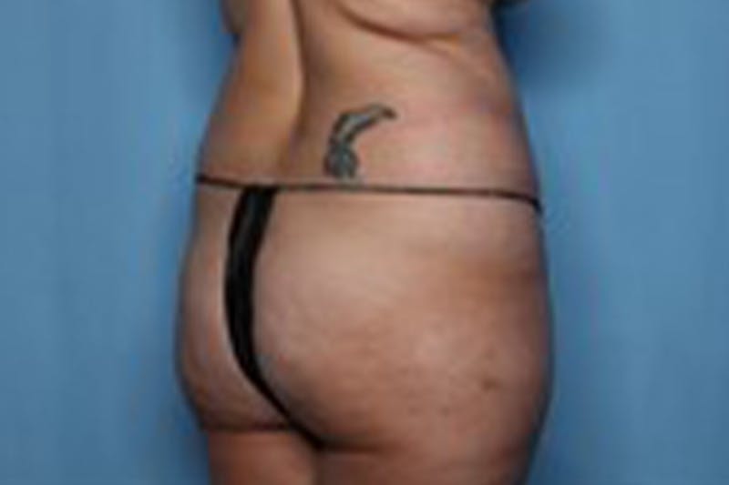 Liposuction Before & After Gallery - Patient 211307 - Image 9