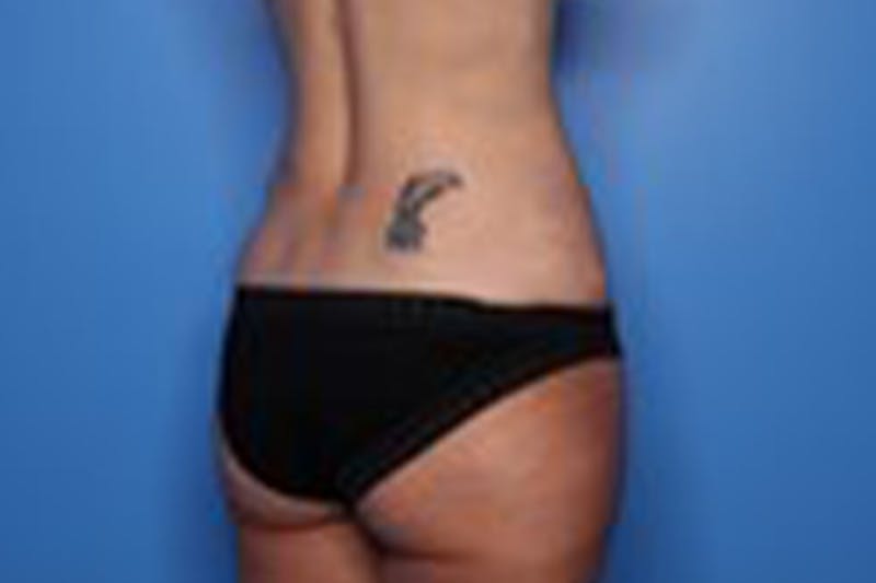 Liposuction Before & After Gallery - Patient 211307 - Image 10