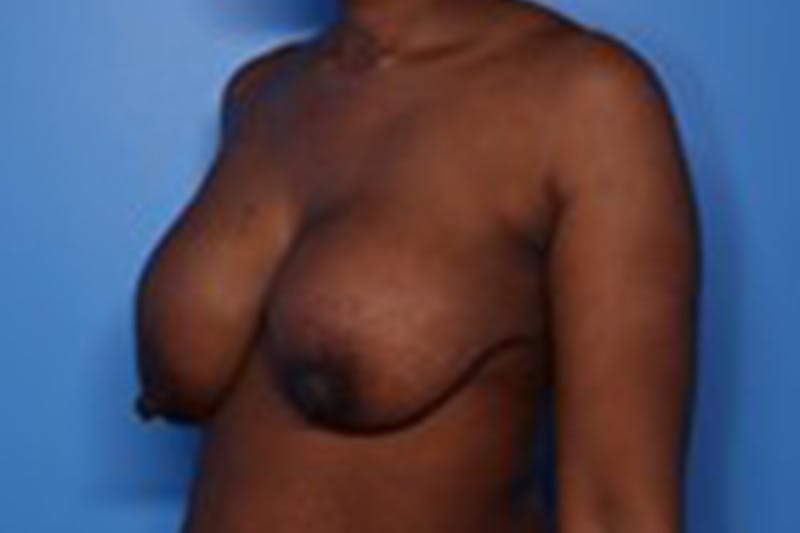 Implant Exchange Before & After Gallery - Patient 260667 - Image 3