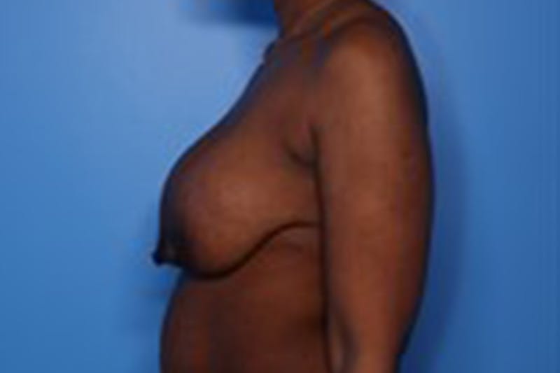 Implant Exchange Before & After Gallery - Patient 260667 - Image 5