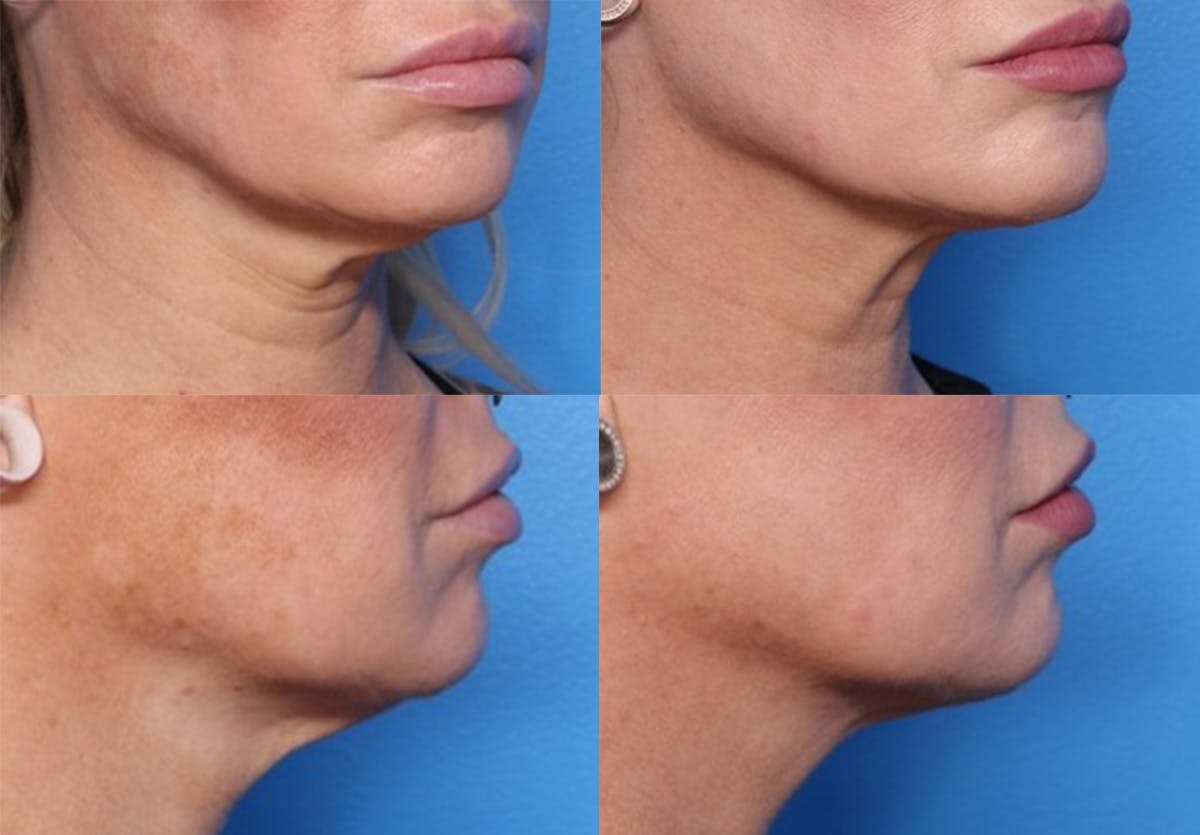 FaceTite Before and After Before & After Gallery - Patient 193876 - Image 1