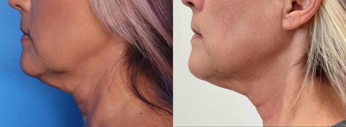 Morpheus8® Before & After Gallery - Patient 226797 - Image 1