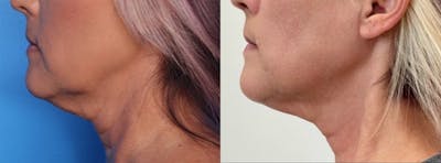 Morpheus8® Before & After Gallery - Patient 226797 - Image 1