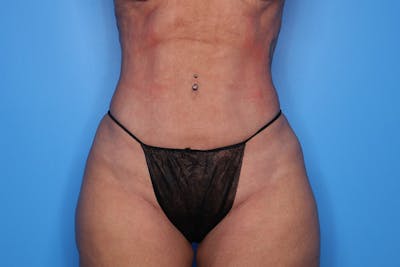 BodyTite™ Before and After Before & After Gallery - Patient 376284 - Image 2