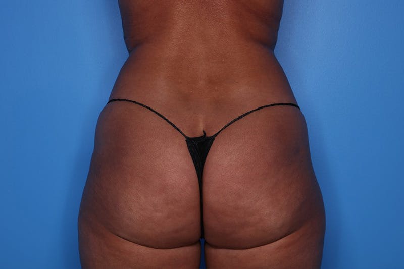 BodyTite™ Before and After Before & After Gallery - Patient 376284 - Image 7