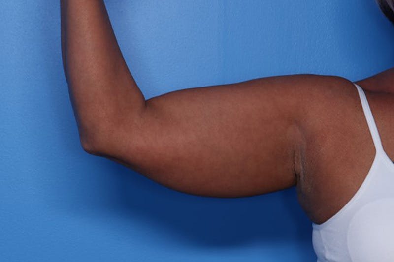 BodyTite™ Before and After Before & After Gallery - Patient 376284 - Image 13