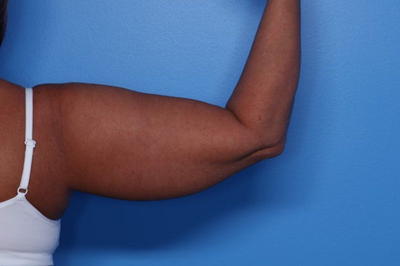 BodyTite™ Before and After Before & After Gallery - Patient 376284 - Image 11