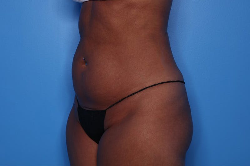 BodyTite™ Before and After Before & After Gallery - Patient 376284 - Image 3