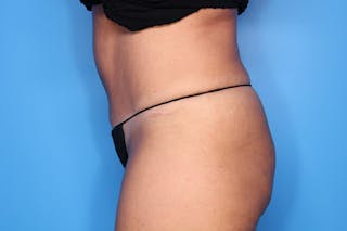 Tummy Tuck Before & After Gallery - Patient 270933 - Image 4