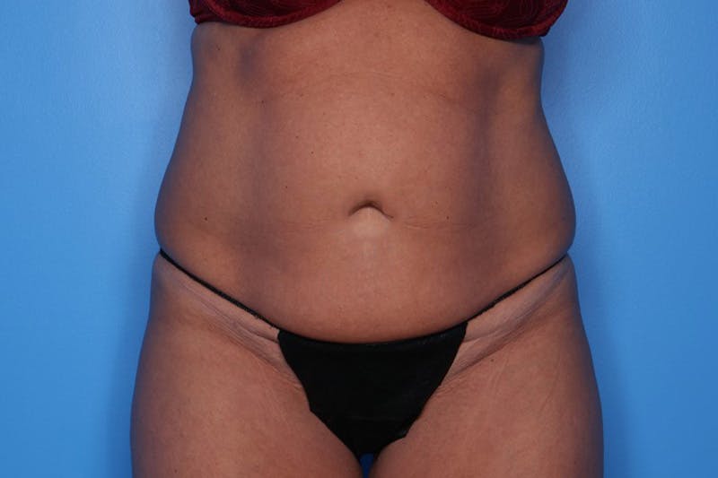 Tummy Tuck Before & After Gallery - Patient 270933 - Image 1