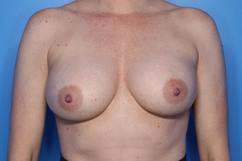 Implant Exchange Before & After Gallery - Patient 878554 - Image 1