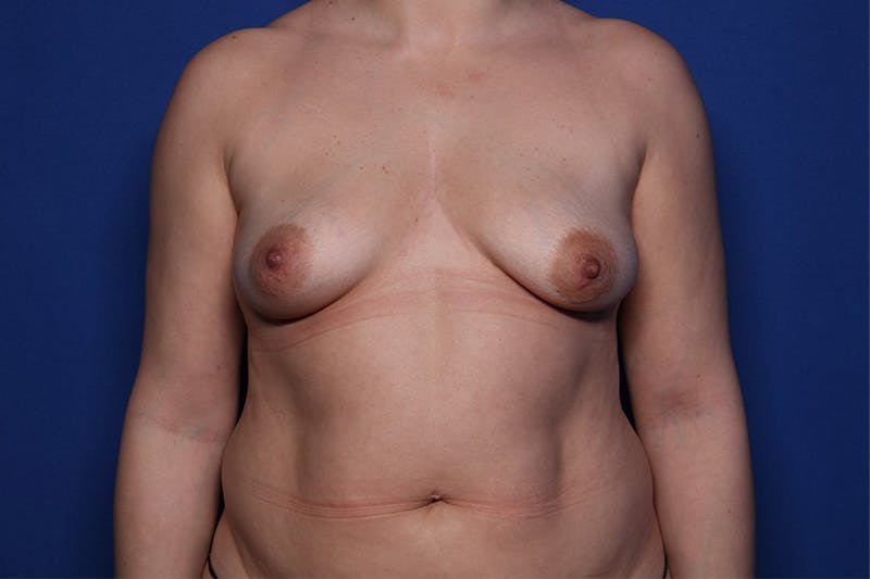 Breast Augmentation Before & After Gallery - Patient 332490 - Image 1