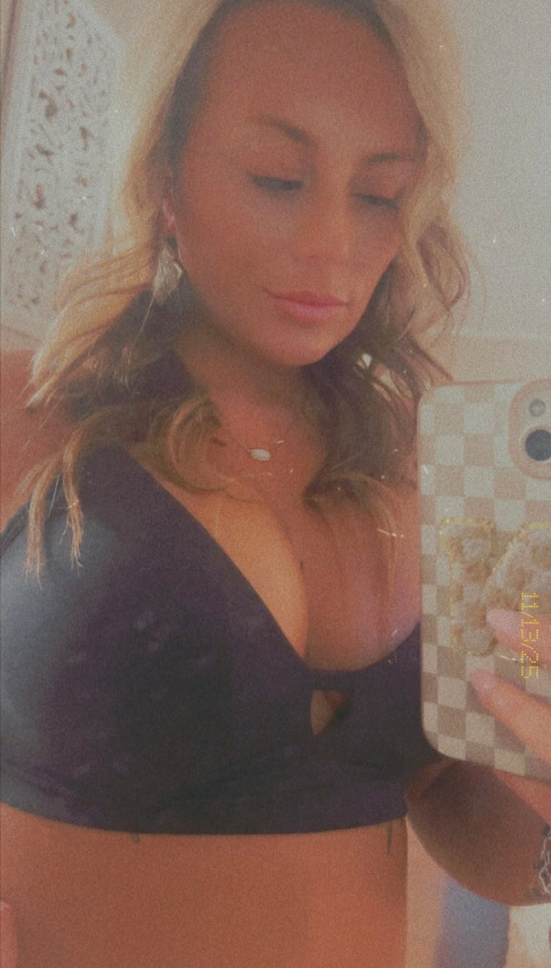 Patient Selfies Before & After Gallery - Patient 301466 - Image 2