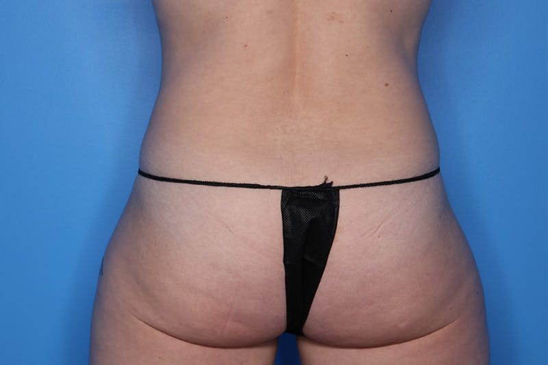 Tummy Tuck Before & After Gallery - Patient 279280 - Image 7