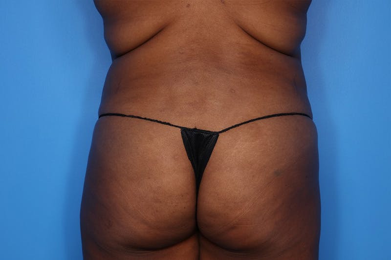 BodyTite™ Before and After Before & After Gallery - Patient 541275 - Image 3