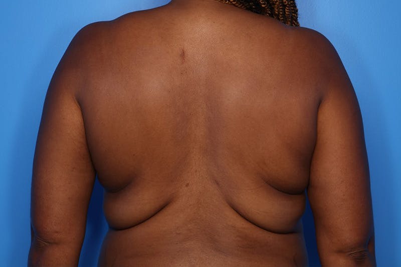 BodyTite™ Before and After Before & After Gallery - Patient 541275 - Image 5