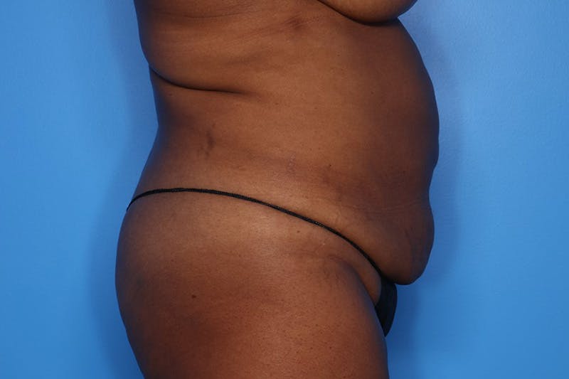 BodyTite™ Before and After Before & After Gallery - Patient 541275 - Image 1