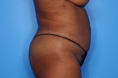 BodyTite™ Before and After Before & After Gallery - Patient 541275 - Image 2