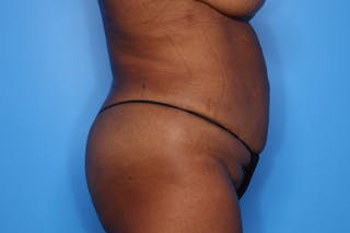 BodyTite™ Before and After Before & After Gallery - Patient 541275 - Image 2